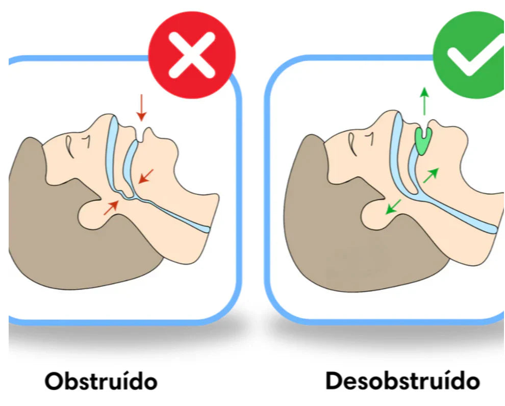 PROTECTOR BUCAL ANTIRONQUIDOS + ENVIO GRATIS